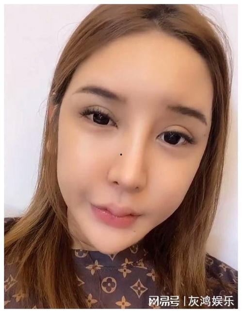 网红整容脸额头